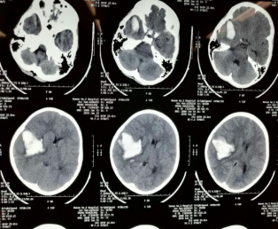 脑病科 特色优势诊疗技术1123.png